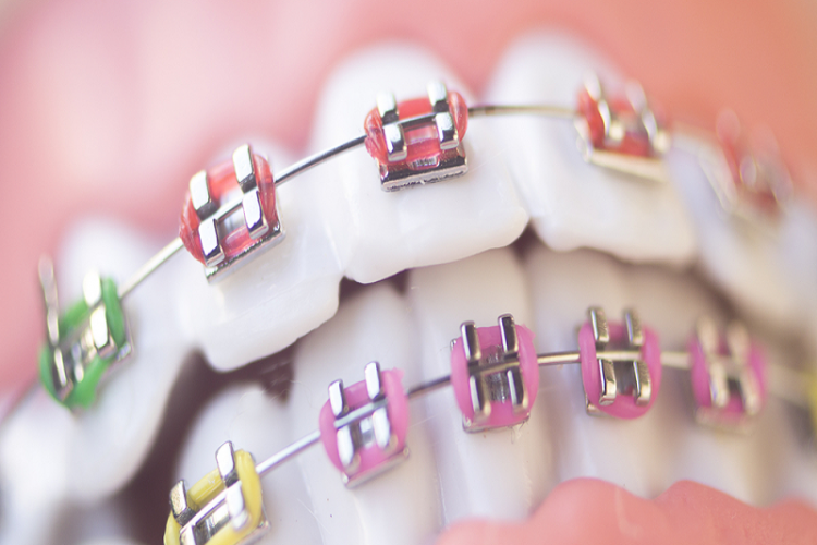 Ortodonti (Diş Teli)